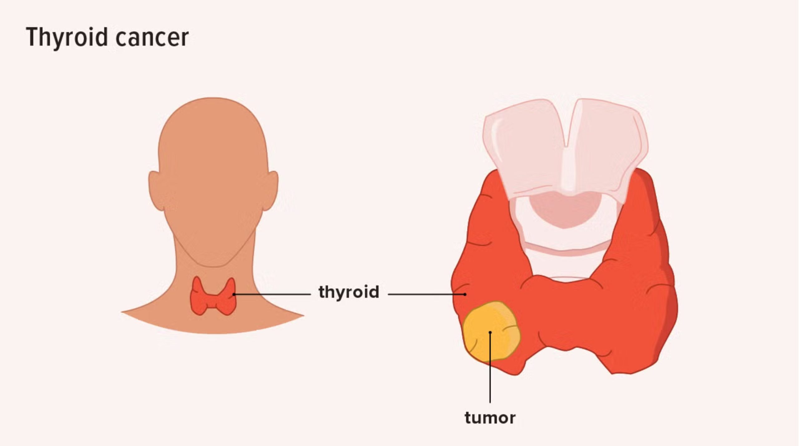 Mounjaro Thyroid